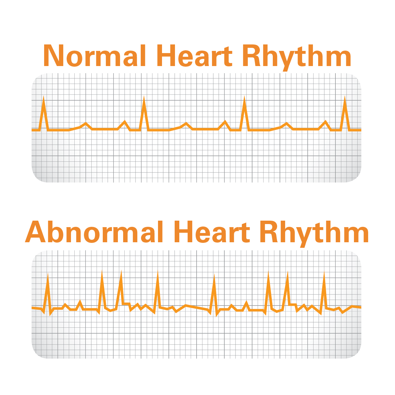 Atrial Fibrillation Diagnosis Get Smart About Afib